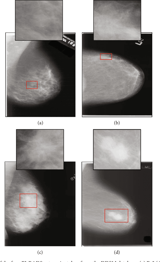 Figure 1 for A New Computer-Aided Diagnosis System with Modified Genetic Feature Selection for BI-RADS Classification of Breast Masses in Mammograms