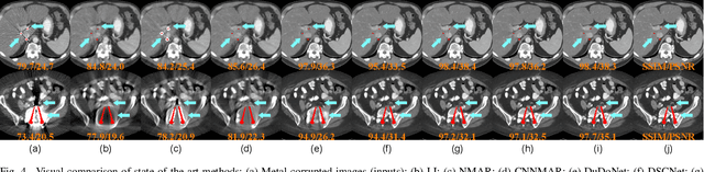 Figure 4 for FD-MAR: Fourier Dual-domain Network for CT Metal Artifact Reduction