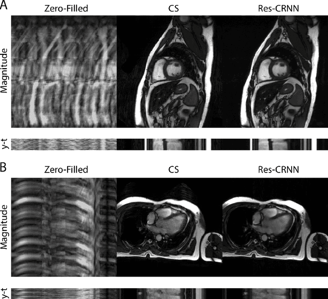 Figure 2 for Real-Time Cardiac Cine MRI with Residual Convolutional Recurrent Neural Network