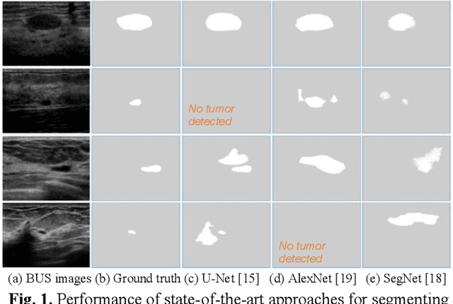 Figure 1 for Stan: Small tumor-aware network for breast ultrasound image segmentation