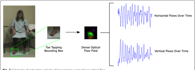 Figure 3 for Vision-Based Assessment of Parkinsonism and Levodopa-Induced Dyskinesia with Deep Learning Pose Estimation