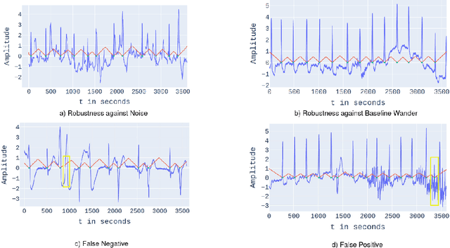 Figure 3 for RPnet: A Deep Learning approach for robust R Peak detection in noisy ECG