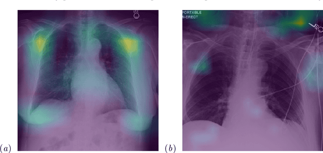 Figure 4 for Deep Learning Applied to Chest X-Rays: Exploiting and Preventing Shortcuts