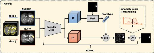 Figure 1 for Anomaly Detection-Inspired Few-Shot Medical Image Segmentation Through Self-Supervision With Supervoxels