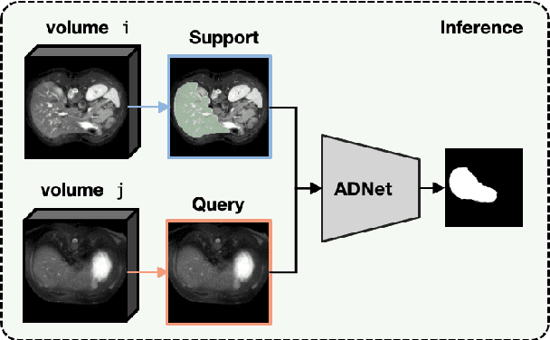 Figure 3 for Anomaly Detection-Inspired Few-Shot Medical Image Segmentation Through Self-Supervision With Supervoxels