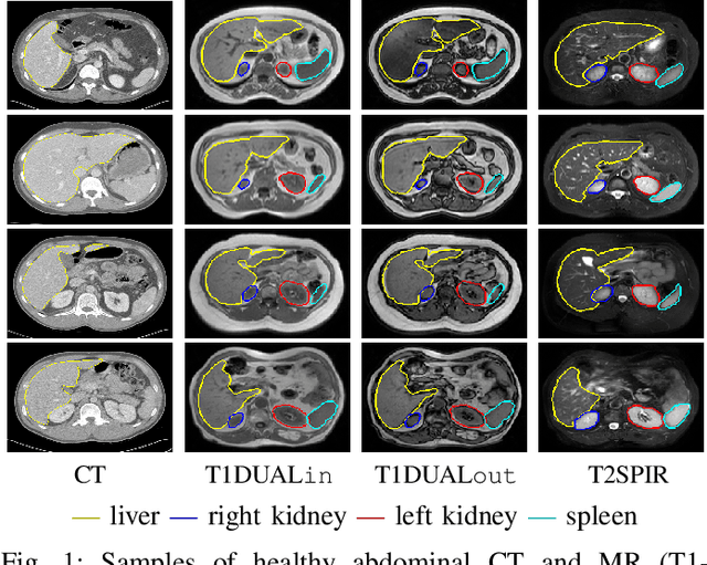 Figure 1 for Abdominal multi-organ segmentation with cascaded convolutional and adversarial deep networks