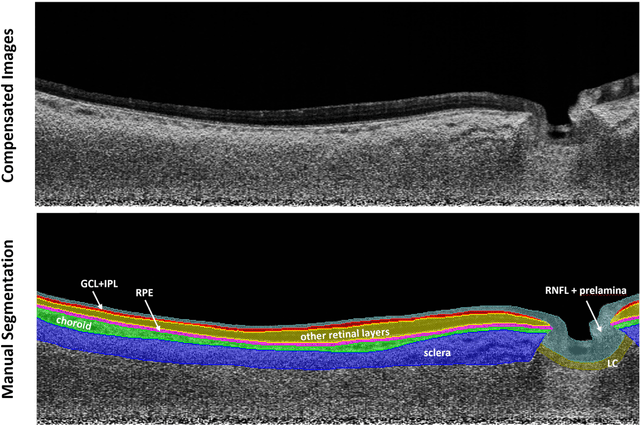 Figure 2 for Are Macula or Optic Nerve Head Structures better at Diagnosing Glaucoma? An Answer using AI and Wide-Field Optical Coherence Tomography