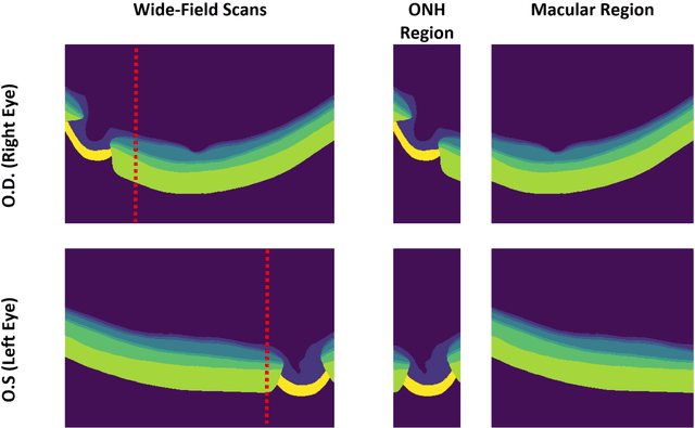 Figure 3 for Are Macula or Optic Nerve Head Structures better at Diagnosing Glaucoma? An Answer using AI and Wide-Field Optical Coherence Tomography