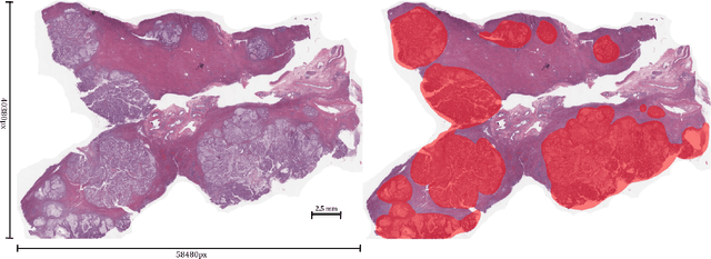 Figure 1 for Towards Unsupervised Cancer Subtyping: Predicting Prognosis Using A Histologic Visual Dictionary
