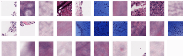 Figure 3 for Towards Unsupervised Cancer Subtyping: Predicting Prognosis Using A Histologic Visual Dictionary