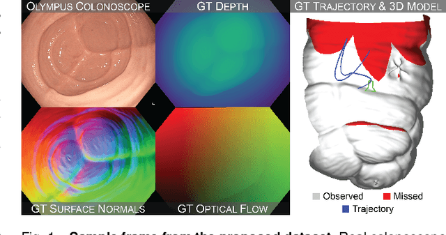 Figure 1 for Colonoscopy 3D Video Dataset with Paired Depth from 2D-3D Registration