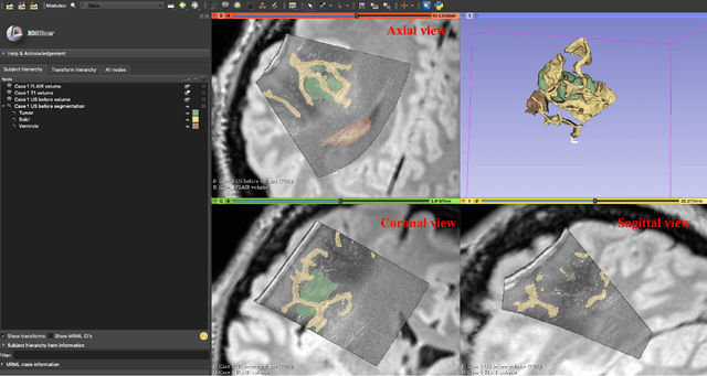 Figure 2 for RESECT-SEG: Open access annotations of intra-operative brain tumor ultrasound images