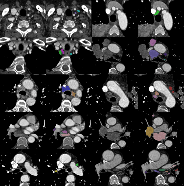 Figure 1 for Mediastinal lymph nodes segmentation using 3D convolutional neural network ensembles and anatomical priors guiding