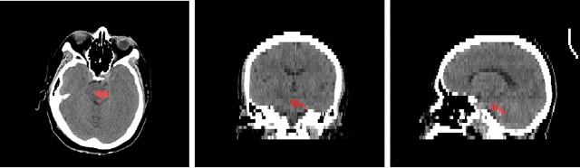 Figure 1 for Automated segmentation of intracranial hemorrhages from 3D CT