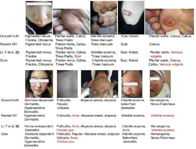 Figure 4 for Learning Differential Diagnosis of Skin Conditions with Co-occurrence Supervision using Graph Convolutional Networks