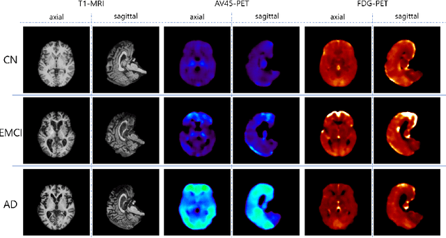 Figure 1 for GANDALF: Generative Adversarial Networks with Discriminator-Adaptive Loss Fine-tuning for Alzheimer's Disease Diagnosis from MRI