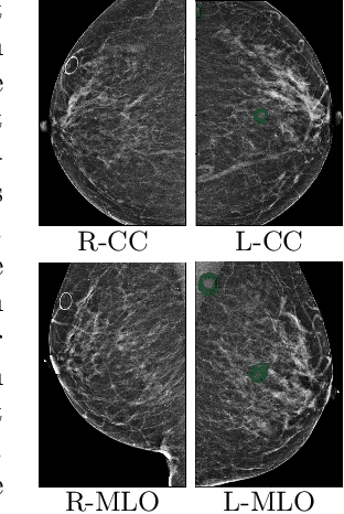 Figure 2 for Globally-Aware Multiple Instance Classifier for Breast Cancer Screening