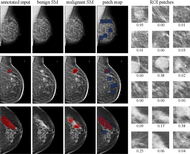 Figure 4 for Globally-Aware Multiple Instance Classifier for Breast Cancer Screening