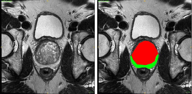 Figure 1 for Automatic segmentation of prostate zones