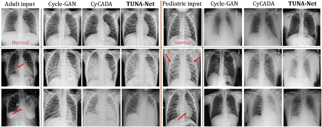 Figure 3 for TUNA-Net: Task-oriented UNsupervised Adversarial Network for Disease Recognition in Cross-Domain Chest X-rays