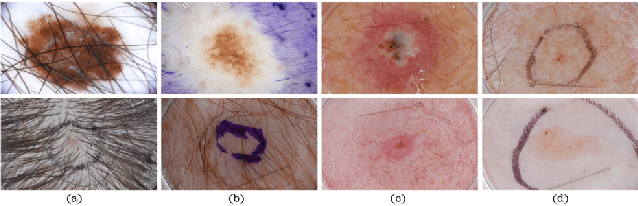 Figure 1 for SANet:Superpixel Attention Network for Skin Lesion Attributes Detection