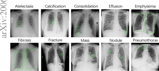 Figure 1 for ChestX-Det10: Chest X-ray Dataset on Detection of Thoracic Abnormalities