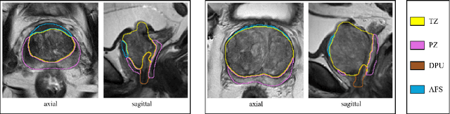 Figure 1 for Uncertainty-Aware Temporal Self-Learning (UATS): Semi-Supervised Learning for Segmentation of Prostate Zones and Beyond