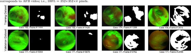 Figure 3 for ESFPNet: efficient deep learning architecture for real-time lesion segmentation in autofluorescence bronchoscopic video
