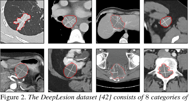 Figure 3 for Accurate Weakly Supervised Deep Lesion Segmentation on CT Scans: Self-Paced 3D Mask Generation from RECIST