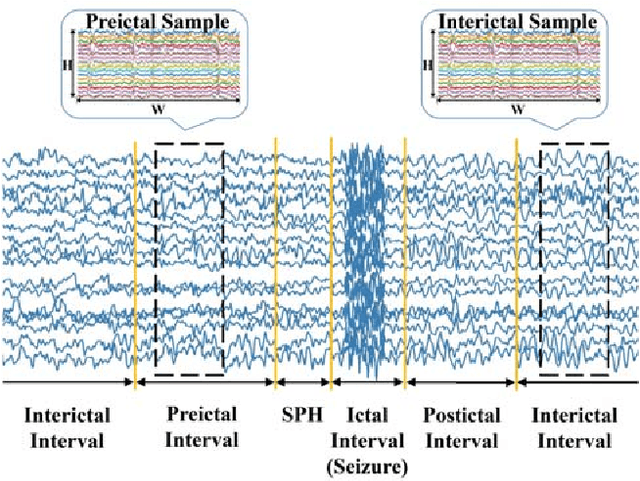 Figure 1 for An End-to-End Deep Learning Approach for Epileptic Seizure Prediction