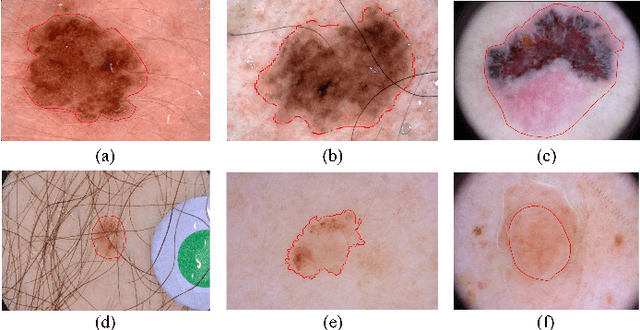 Figure 1 for Semi- and Weakly Supervised Directional Bootstrapping Model for Automated Skin Lesion Segmentation