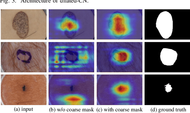 Figure 4 for Semi- and Weakly Supervised Directional Bootstrapping Model for Automated Skin Lesion Segmentation