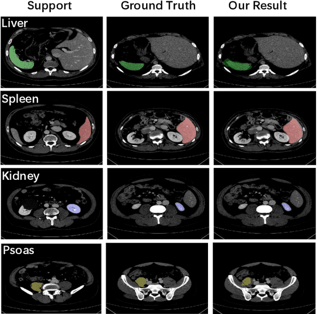 Figure 3 for A Location-Sensitive Local Prototype Network for Few-Shot Medical Image Segmentation