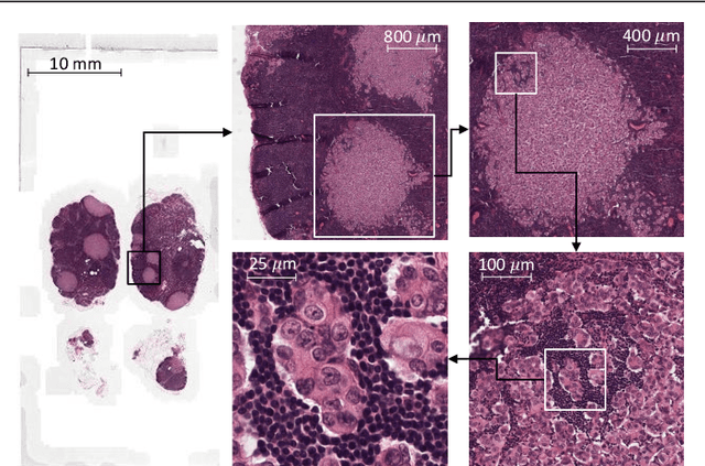 Figure 1 for Representation-Aggregation Networks for Segmentation of Multi-Gigapixel Histology Images