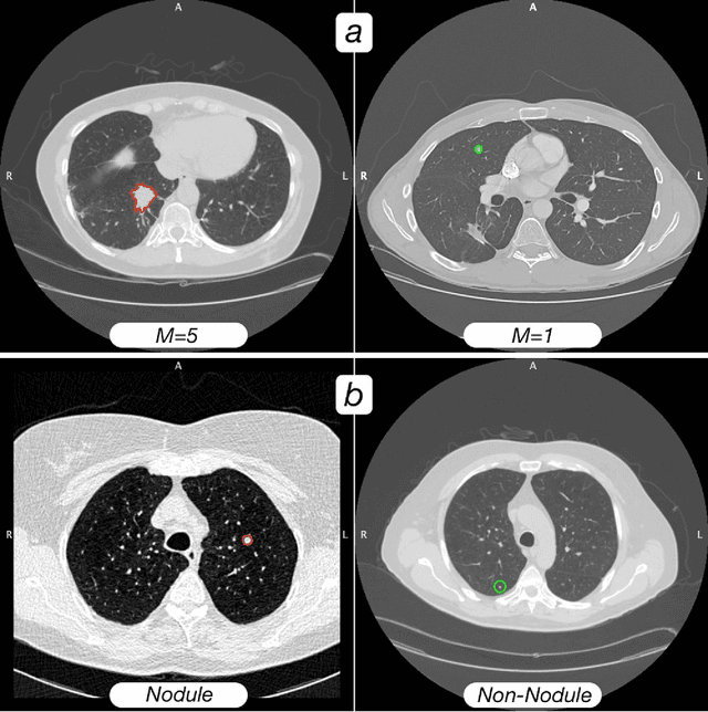 Figure 3 for Highly accurate model for prediction of lung nodule malignancy with CT scans