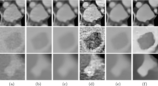 Figure 1 for CT Image Enhancement Using Stacked Generative Adversarial Networks and Transfer Learning for Lesion Segmentation Improvement