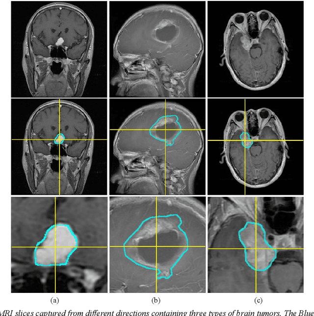 Figure 1 for Brain Tumor Classification by Cascaded Multiscale Multitask Learning Framework Based on Feature Aggregation