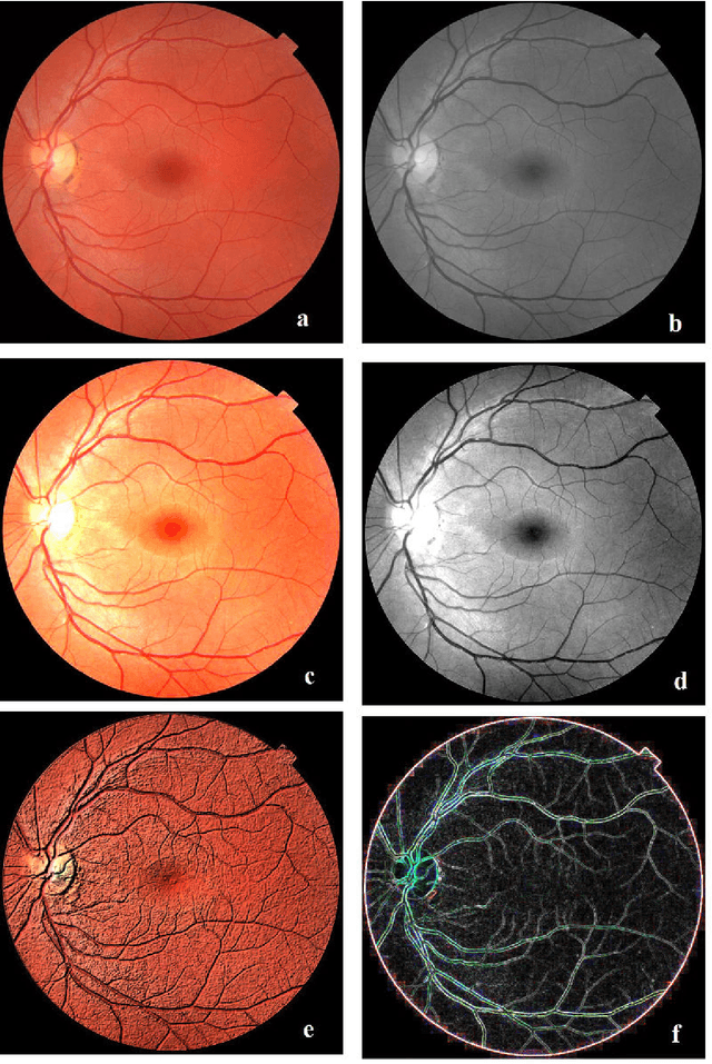 Figure 1 for GIMP and Wavelets for Medical Image Processing: Enhancing Images of the Fundus of the Eye