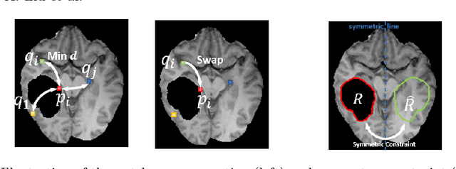 Figure 3 for Symmetric-Constrained Irregular Structure Inpainting for Brain MRI Registration with Tumor Pathology