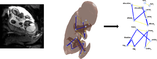 Figure 1 for Enhanced detection of fetal pose in 3D MRI by Deep Reinforcement Learning with physical structure priors on anatomy