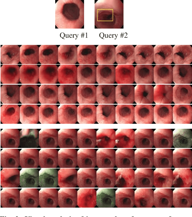 Figure 4 for Efficient video indexing for monitoring disease activity and progression in the upper gastrointestinal tract