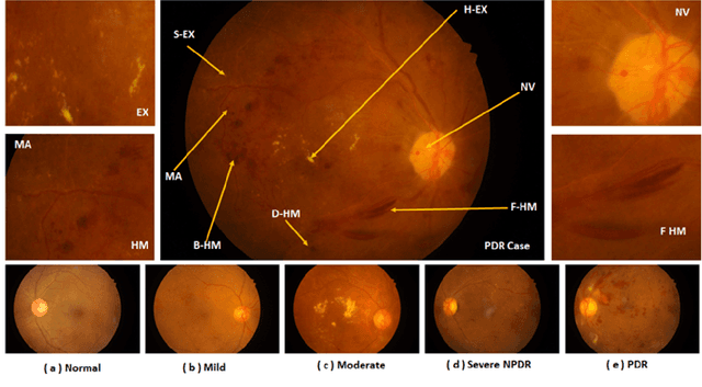 Figure 1 for Diabetic Retinopathy Grading System Based on Transfer Learning