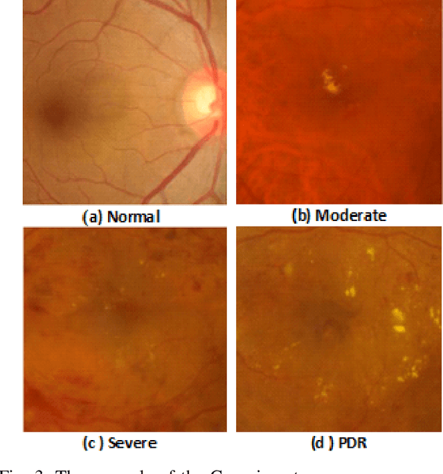 Figure 3 for Diabetic Retinopathy Grading System Based on Transfer Learning
