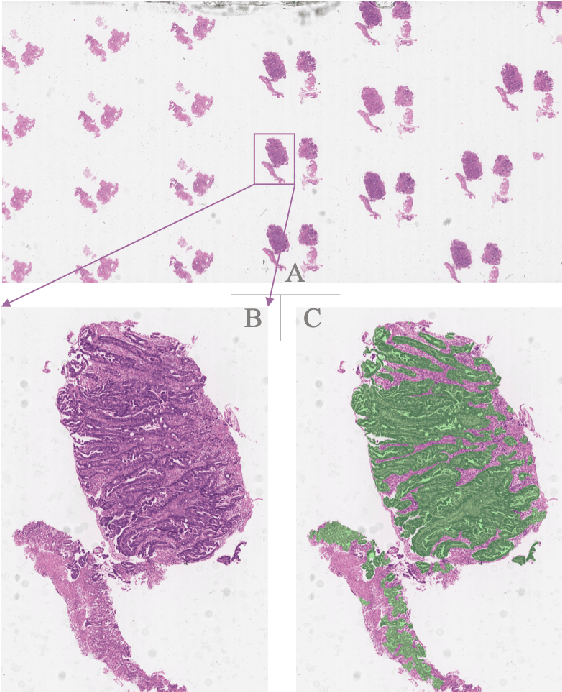 Figure 1 for Large-scale Gastric Cancer Screening and Localization Using Multi-task Deep Neural Network