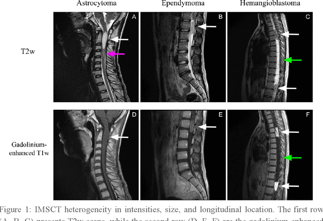 Figure 1 for Multiclass Spinal Cord Tumor Segmentation on MRI with Deep Learning