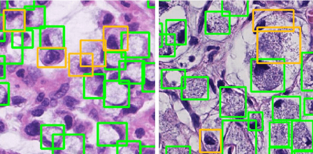 Figure 1 for Signet Ring Cell Detection With a Semi-supervised Learning Framework