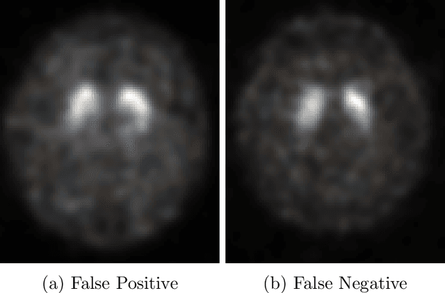 Figure 4 for DaTscan SPECT Image Classification for Parkinson's Disease
