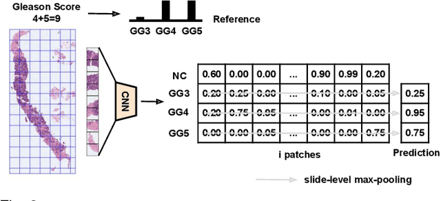 Figure 3 for Self-learning for weakly supervised Gleason grading of local patterns