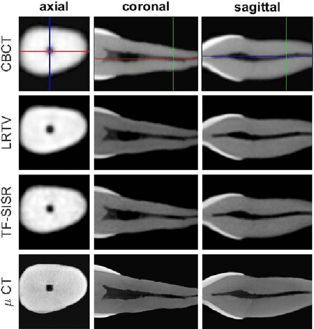 Figure 4 for A Tensor Factorization Method for 3D Super-Resolution with Application to Dental CT