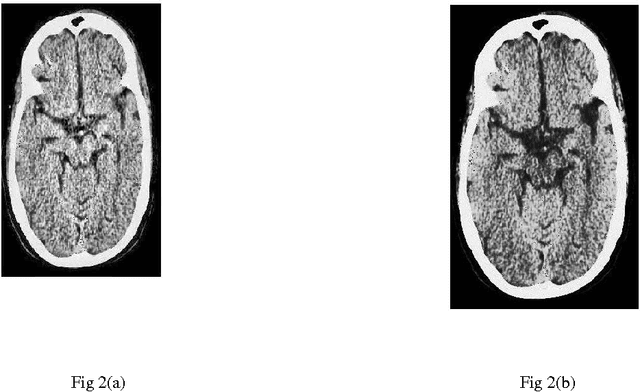 Figure 1 for A comparative study between proposed Hyper Kurtosis based Modified Duo-Histogram Equalization (HKMDHE) and Contrast Limited Adaptive Histogram Equalization (CLAHE) for Contrast Enhancement Purpose of Low Contrast Human Brain CT scan images